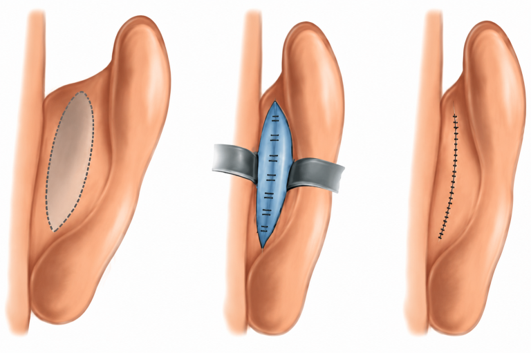 otoplasty